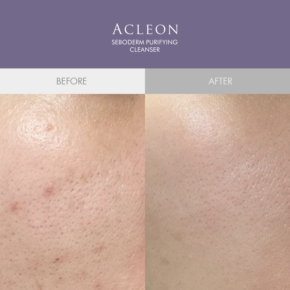 아클레온 클렌징 젤 200ml