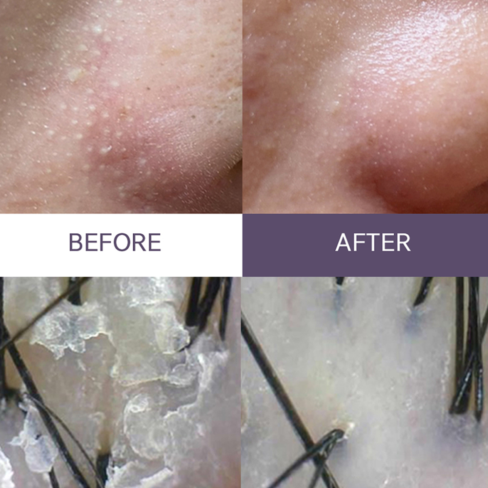 아클레온 피지제거 3종세트 (클렌징젤, 토너, 피지연화제)