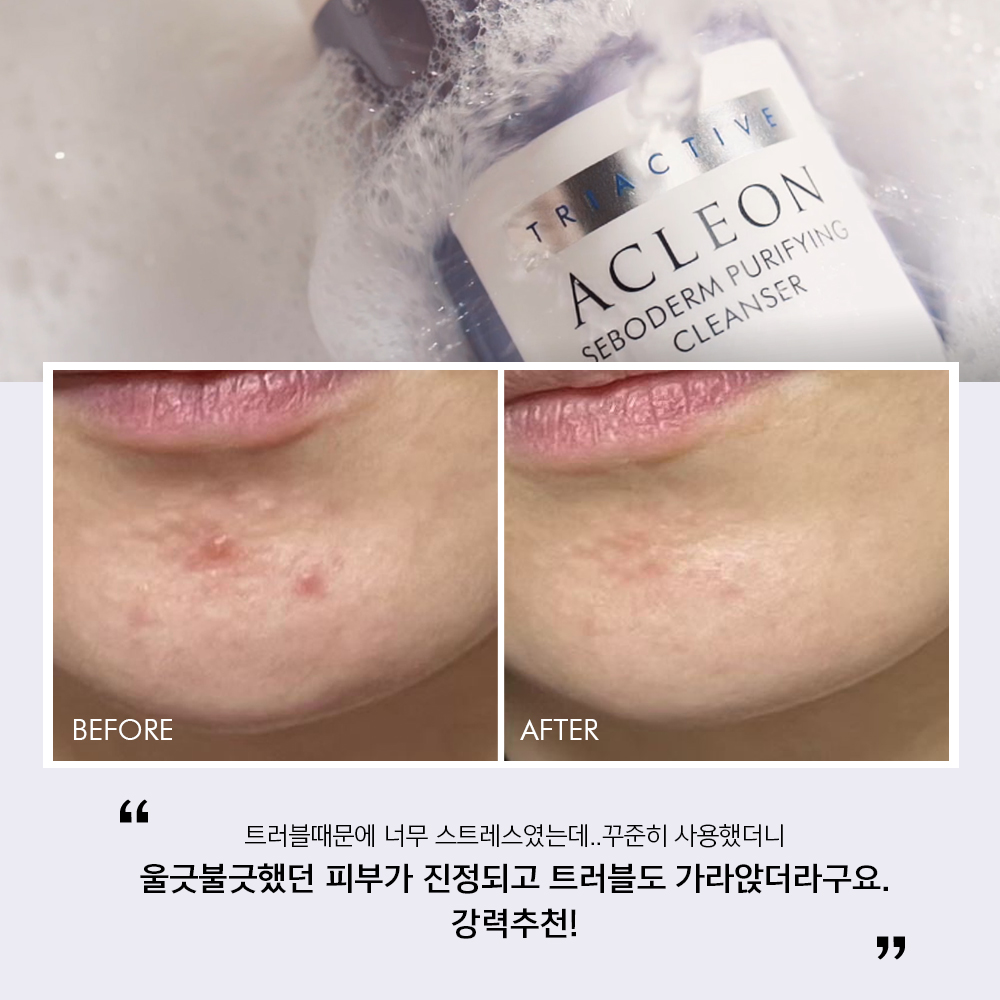 아클레온 지성피부 트러블 여드름 기초 4종 세트 (클렌저, 토닝로션, 스팟, 세럼)