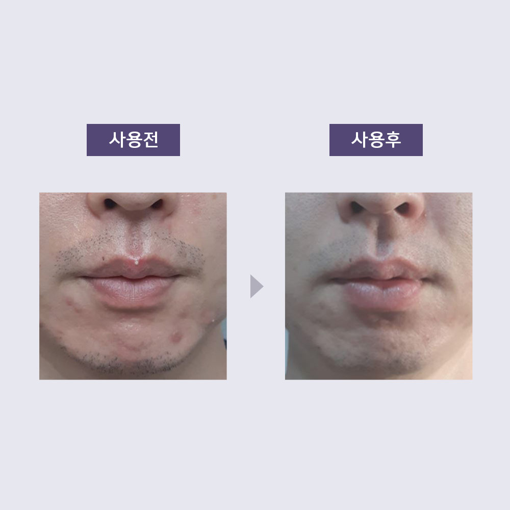 아클레온 블래미쉬 스팟 2개