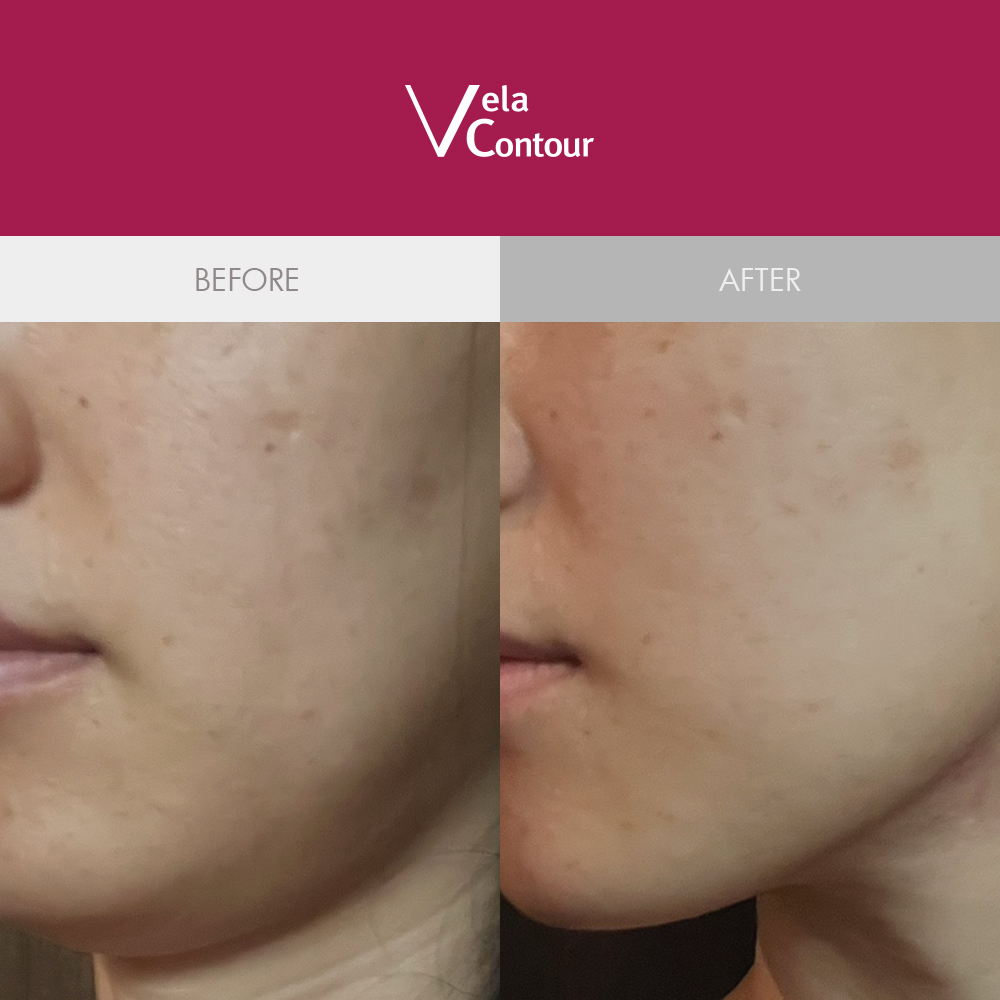 벨라컨투어 브이 컨투어링 세럼 30ml + 리더미스 리싱크 세럼 55ml